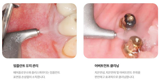 불당치과, 사랑니발치와 천안 치아교정 전문 서비스